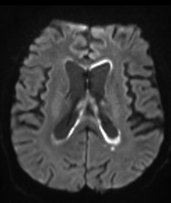CMV