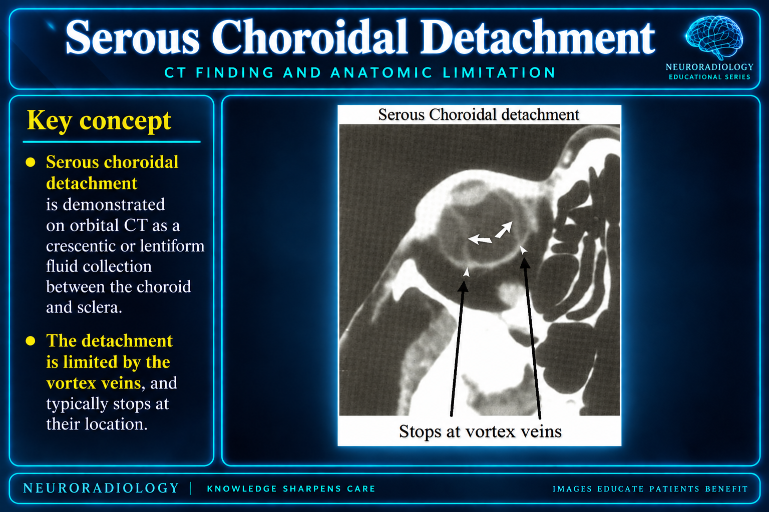 Serous Choroidal Detachment