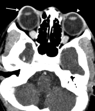 Congenital glaucoma

12-year-old female patient with Opitz syndrome

Markedly enlarged anterior chamber of the right globe (arrow) and mildly enlarged anterior chamber of the left globe