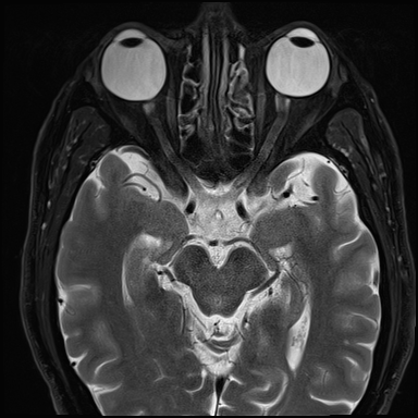 Severe glaucoma 

Both globes are enlarged axially (right 27.5 mm, left 25.8 mm). The optic nerves are small, particularly on the right with commensurately small right side of the chiasm. 

The right optic nerve also has slightly increased T2 signal. 

Conclusion: Increased axial length of both globes, more so on the right, with optic atrophy is attributable to known severe glaucoma. No other cause identified.