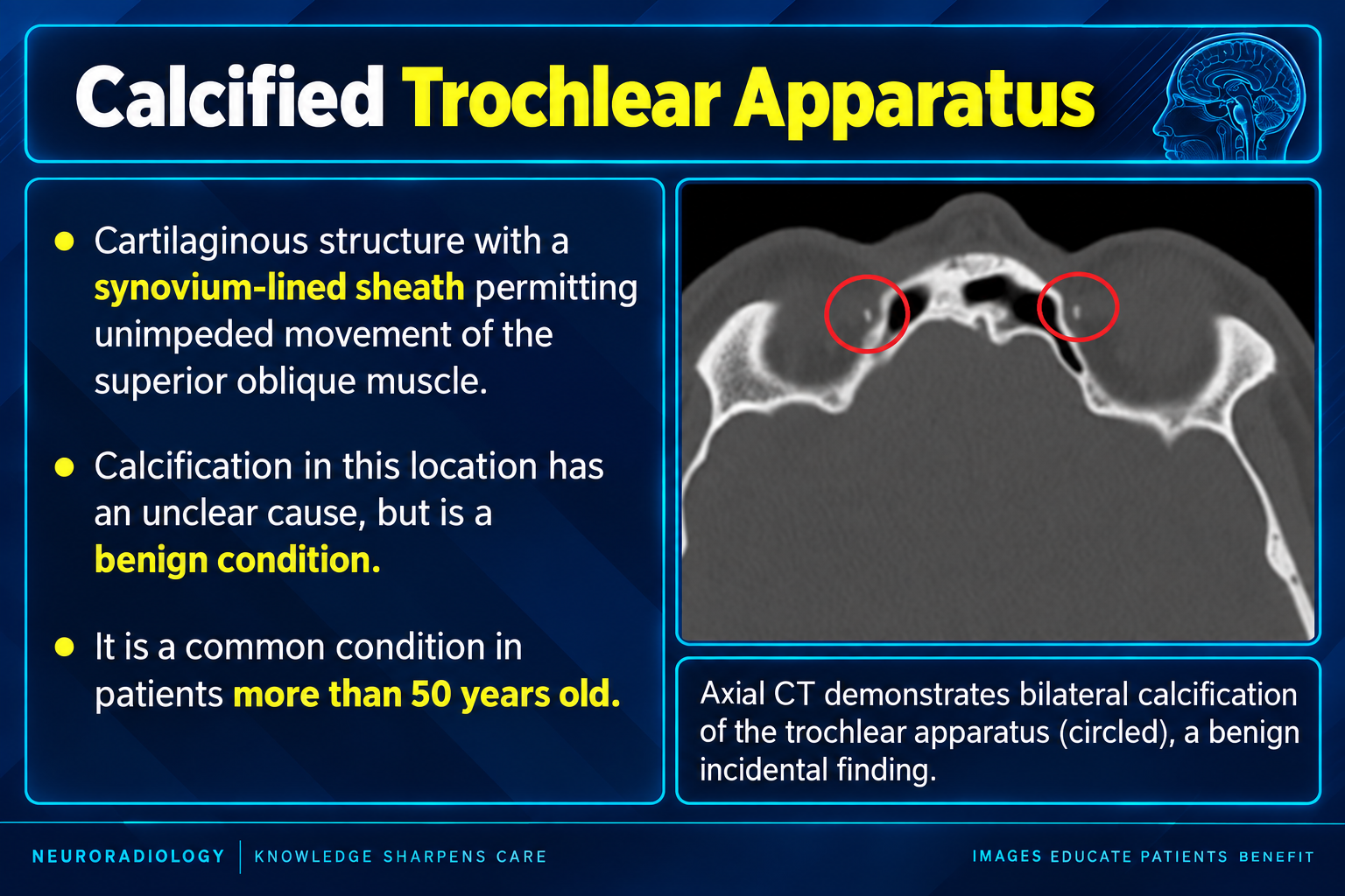 Axial CT showing bilateral calcification of the trochlear apparatus