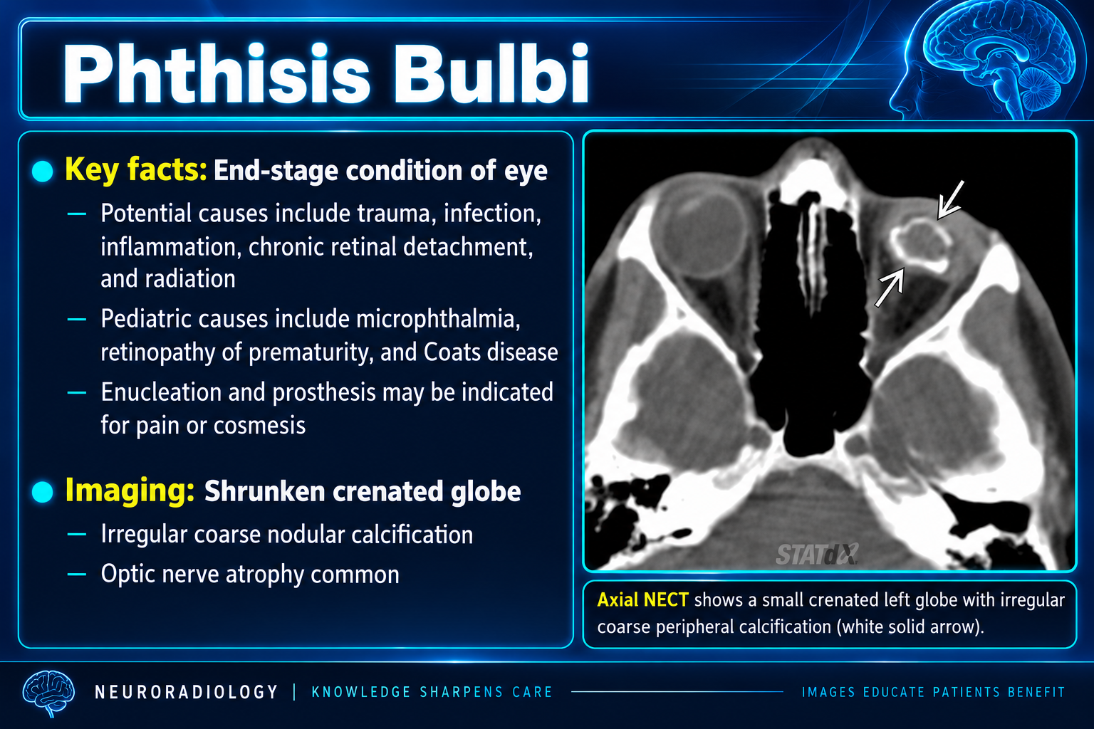 Axial CT showing a small crenated globe with coarse peripheral calcification from phthisis bulbi