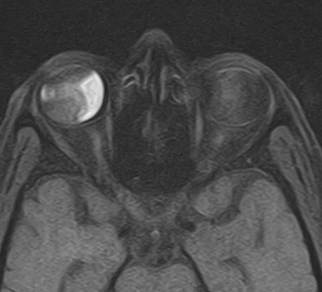 Posterior vitreous hemorrhage