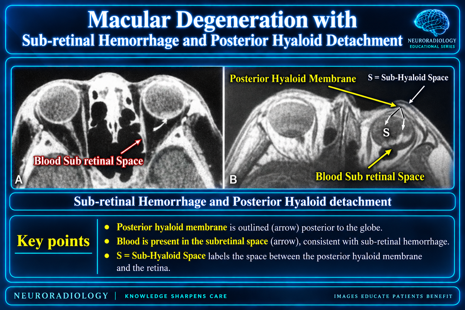 Sub-retinal Hemorrhage