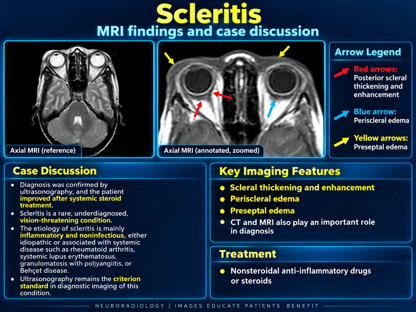 Scleritis