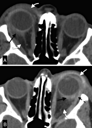 Scleritis
Eccentric thickening and enhancement of the right globe wall with focal periscleral cellulitis (black arrow), compatible with posterior scleritis. 
There is associated pre- and postseptal cellulitis (white arrow) and proptosis. 

(A)	shows almost identical findings in the left orbit. Black and white arrows point to the scleritis and cellulitis, respectively. Notice the complete resolution of the alterations of the right orbit. Also, notice involvement of the tendon of the lateral rectus anteriorly (dashed arrow).

(B)	B, CECT 18 months after examination