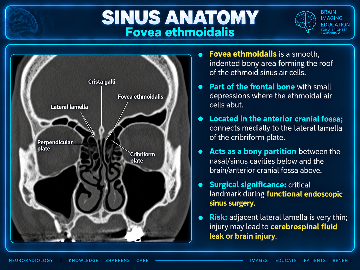 Teaching graphic with coronal CT labels identifying the fovea ethmoidalis, lateral lamella, cribriform plate, crista galli and perpendicular plate.