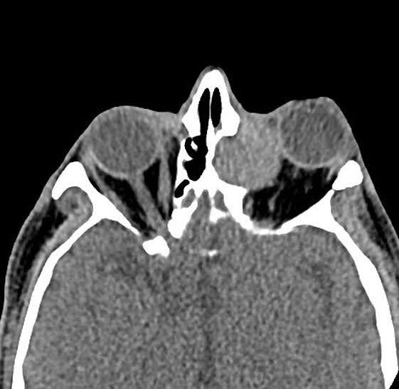 Frontal-ethmoidal