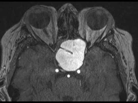 Spenoid