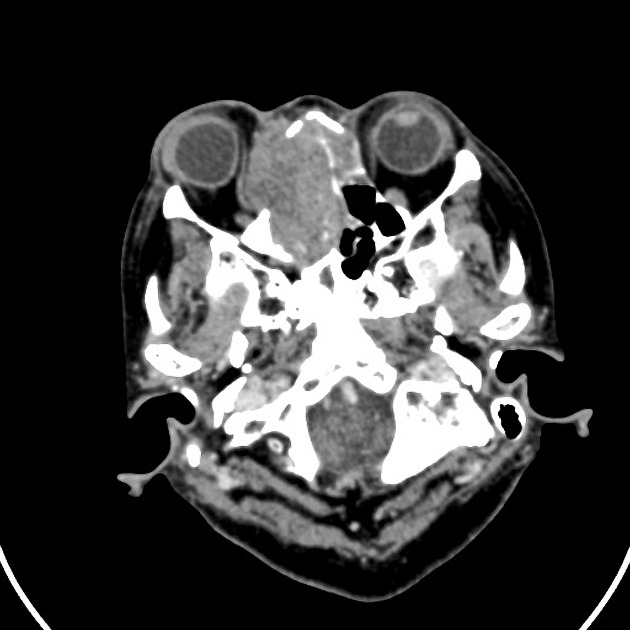 Adenocarcinoma