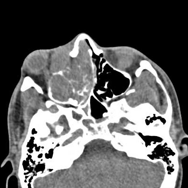 Undifferentiated carcinoma