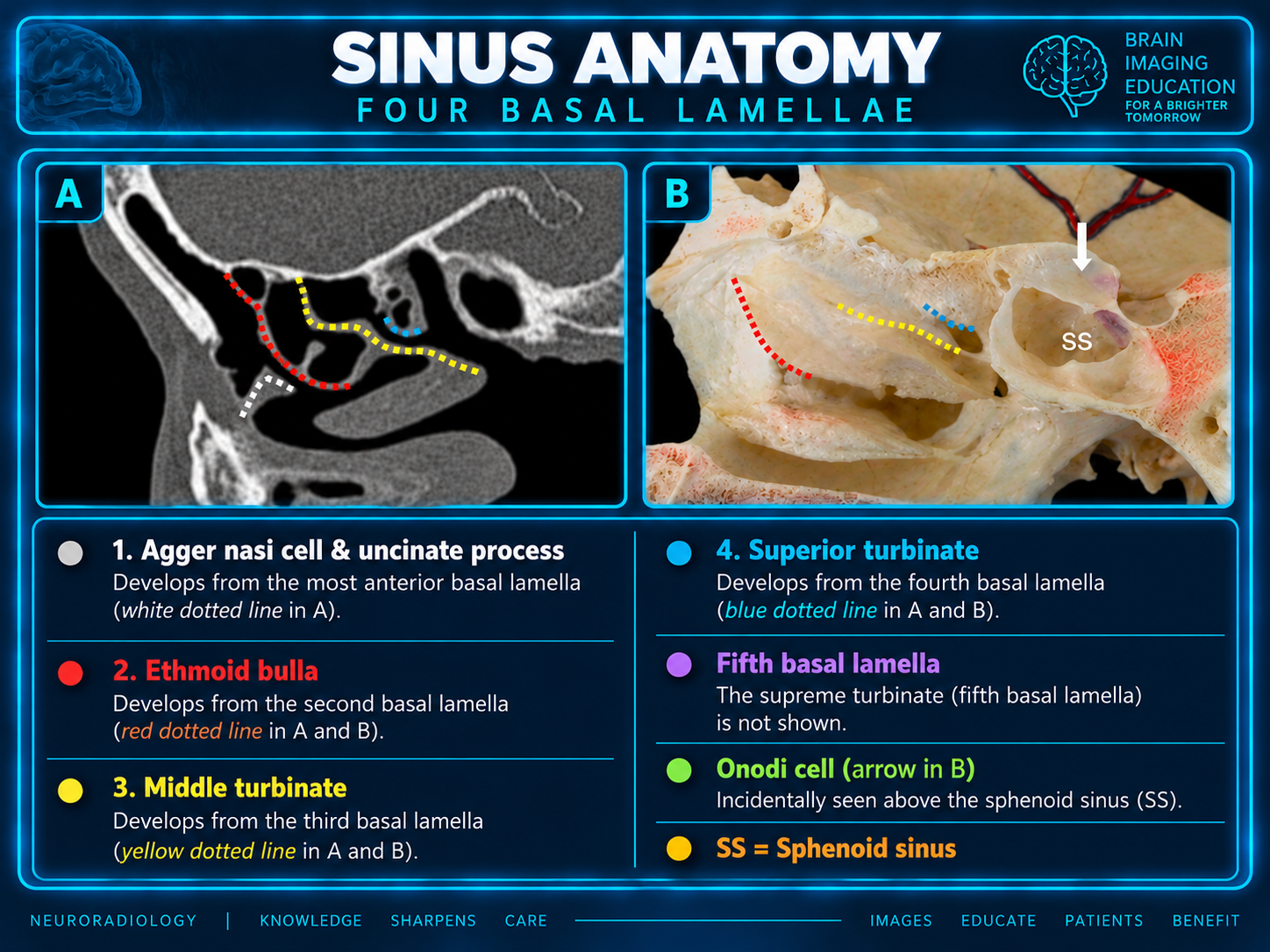 Basal lamellae: sagittal CT and anatomic specimen