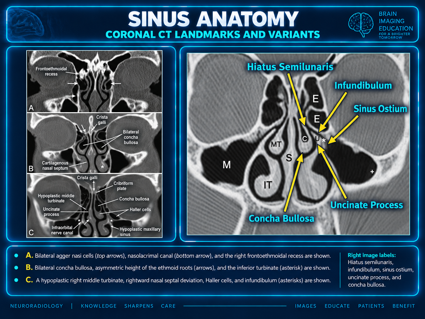 Coronal CT landmarks and variants