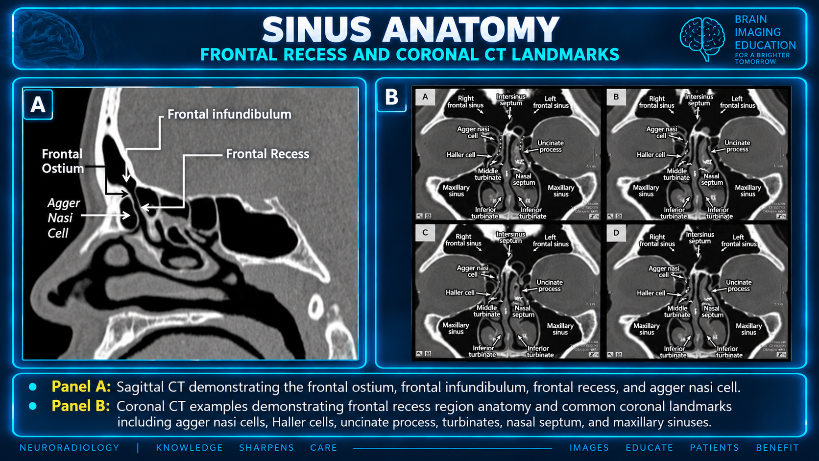 Frontal recess and coronal CT landmarks