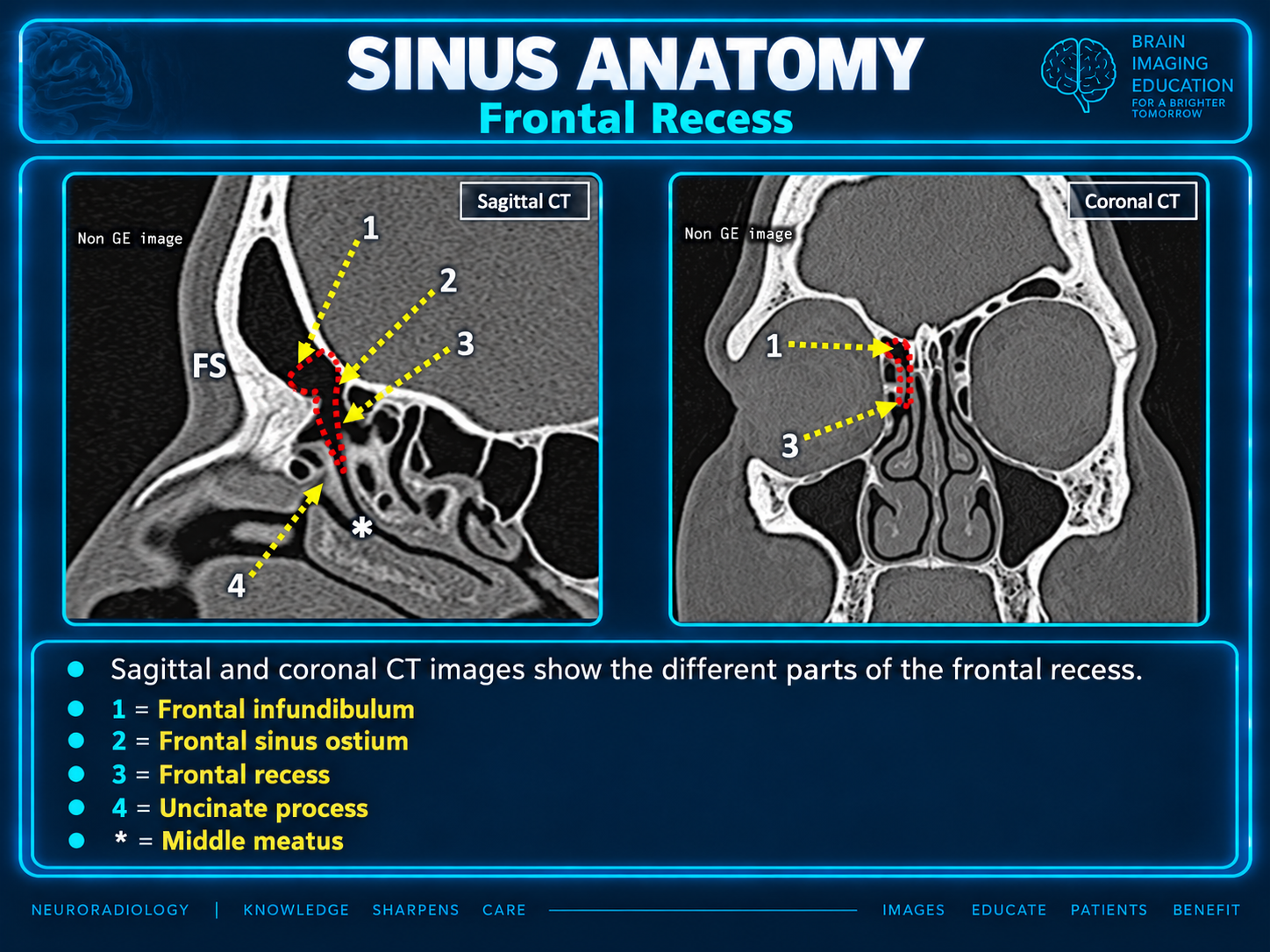 Frontal recess: sagittal and coronal CT