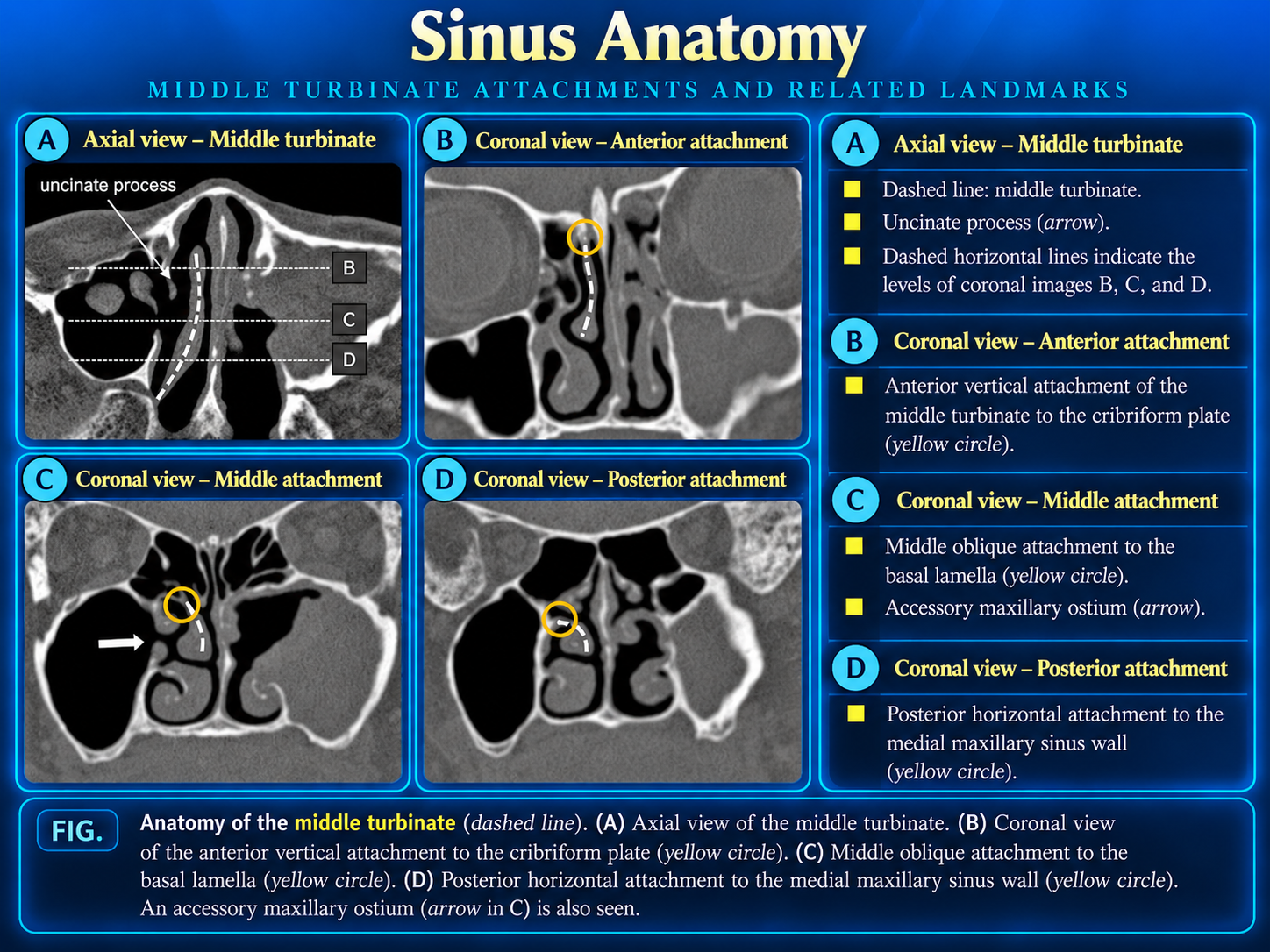 Middle turbinate attachments: axial and coronal CT