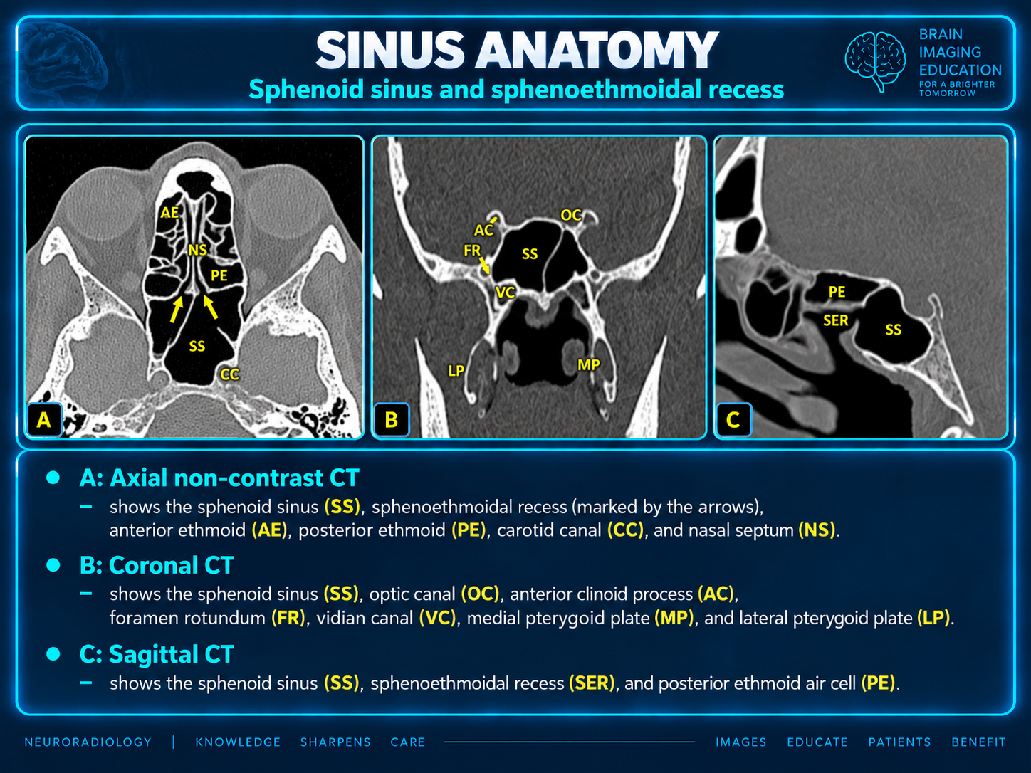 Sphenoid sinus: axial, coronal and sagittal CT