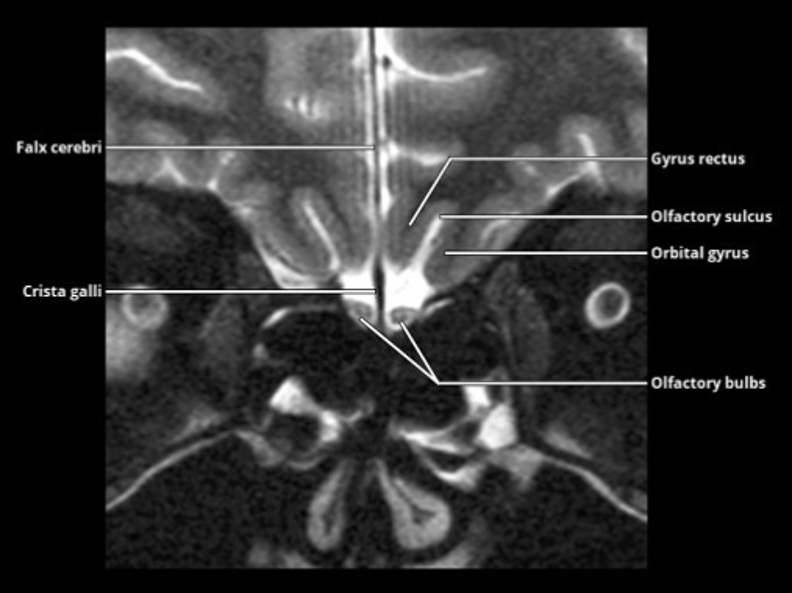 Coronal MRI showing the olfactory bulbs, olfactory sulci, gyri recti, orbital gyri, crista galli, and falx