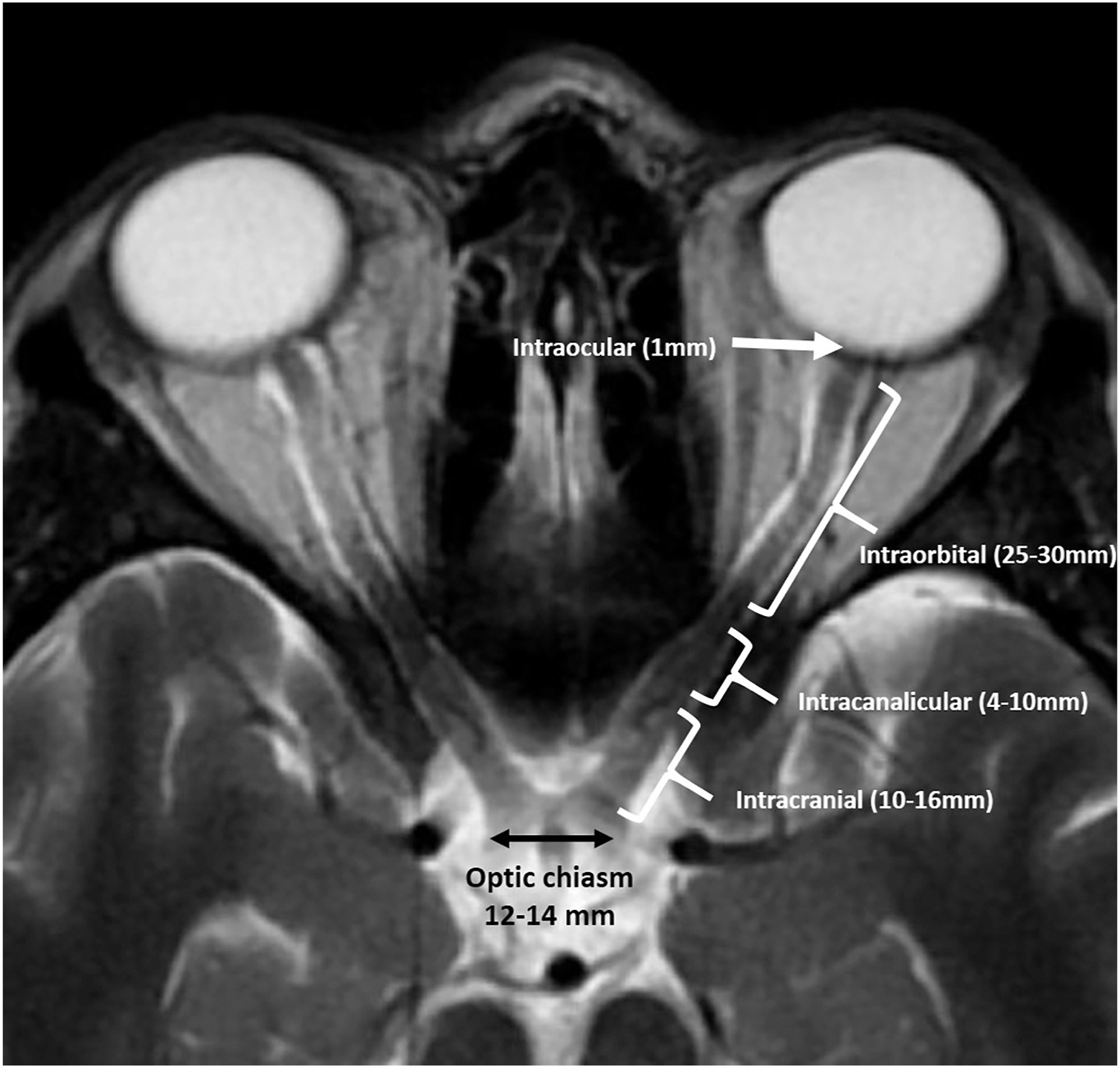 Axial MRI showing the intraocular, intraorbital, intracanalicular, and intracranial optic nerve segments