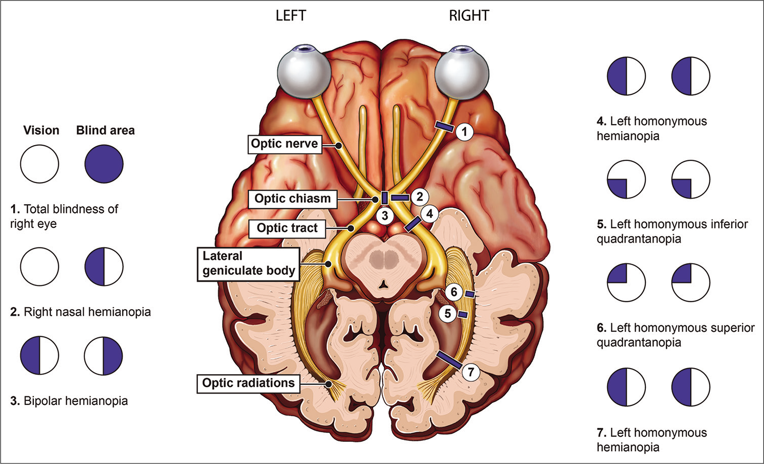 Visual pathway diagram showing characteristic field deficits by lesion location