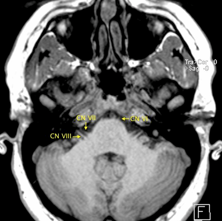Axial MRI showing cranial nerves six, seven, and eight at the brainstem and cerebellopontine angle