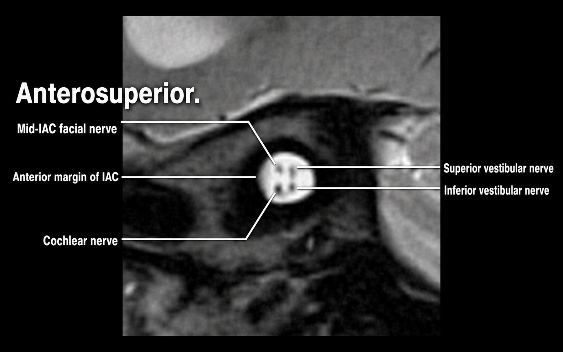 High-resolution MRI showing facial, cochlear, superior vestibular, and inferior vestibular nerves in the internal auditory canal