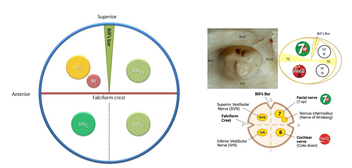 Diagram of facial, cochlear, and vestibular nerve positions at the fundus of the internal auditory canal