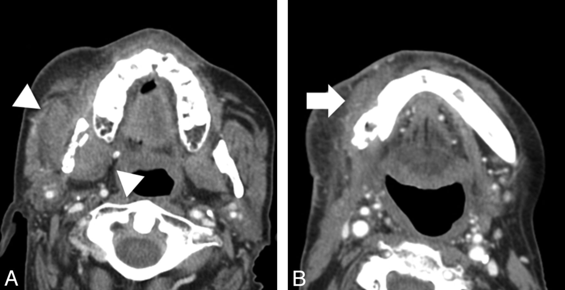 A, Axial CT scan (soft-tissue window) shows enlargement and thickening of the musculature of the right masticator space (white arrowheads), without evidence of a distinct measurable mass, adjacent to an area of osteoradionecrosis. B, Axial CT scan (soft-tissue window) shows inflammatory thickening of soft tissues (white arrow) adjacent to an area of osteoradionecrosis involving the right mandibular body.
