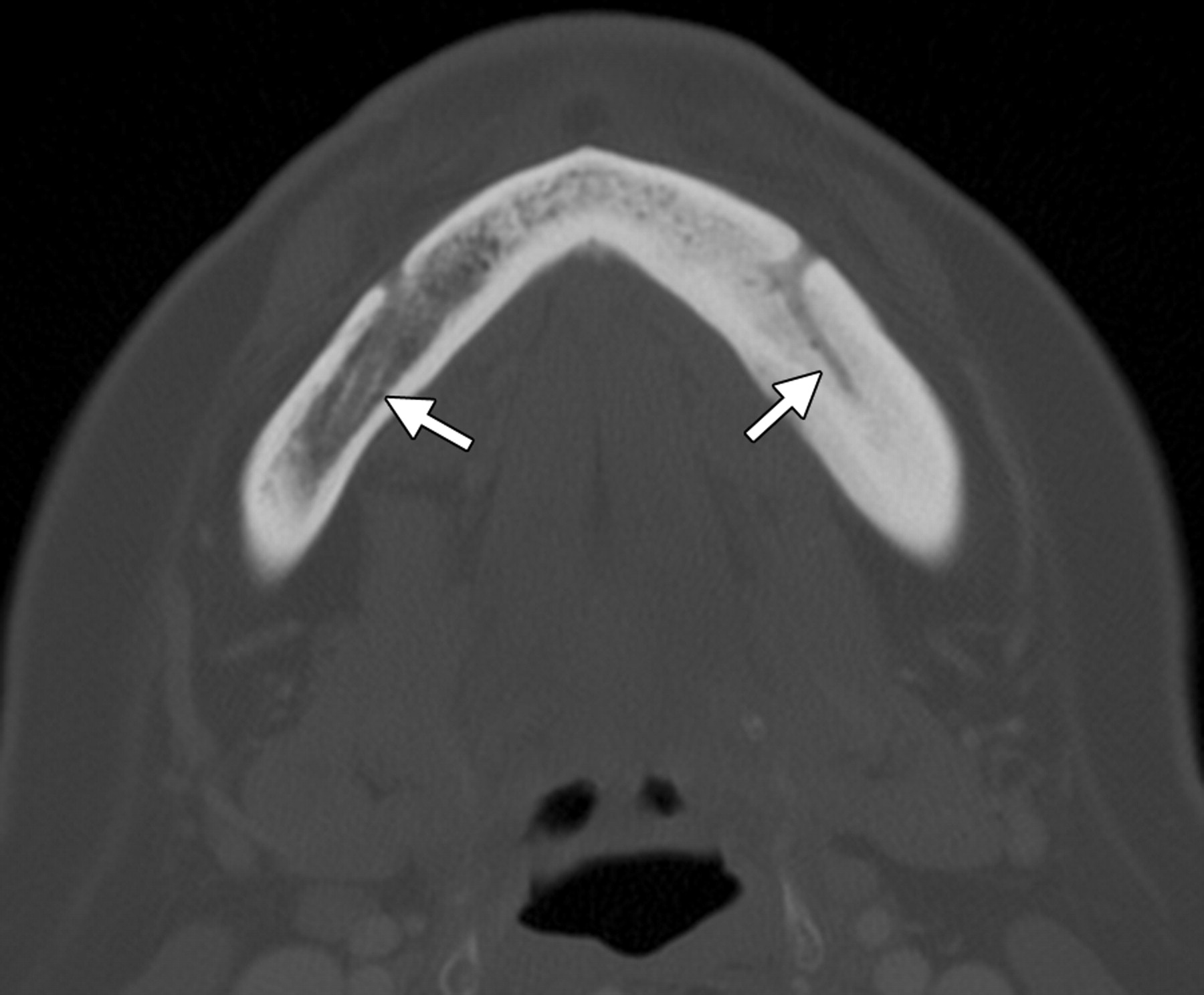 cortical thickening and medullary sclerosis of the left mandible. There is relative narrowing of the inferior alveolar canal (arrows) on the left side in comparison with that on the right.