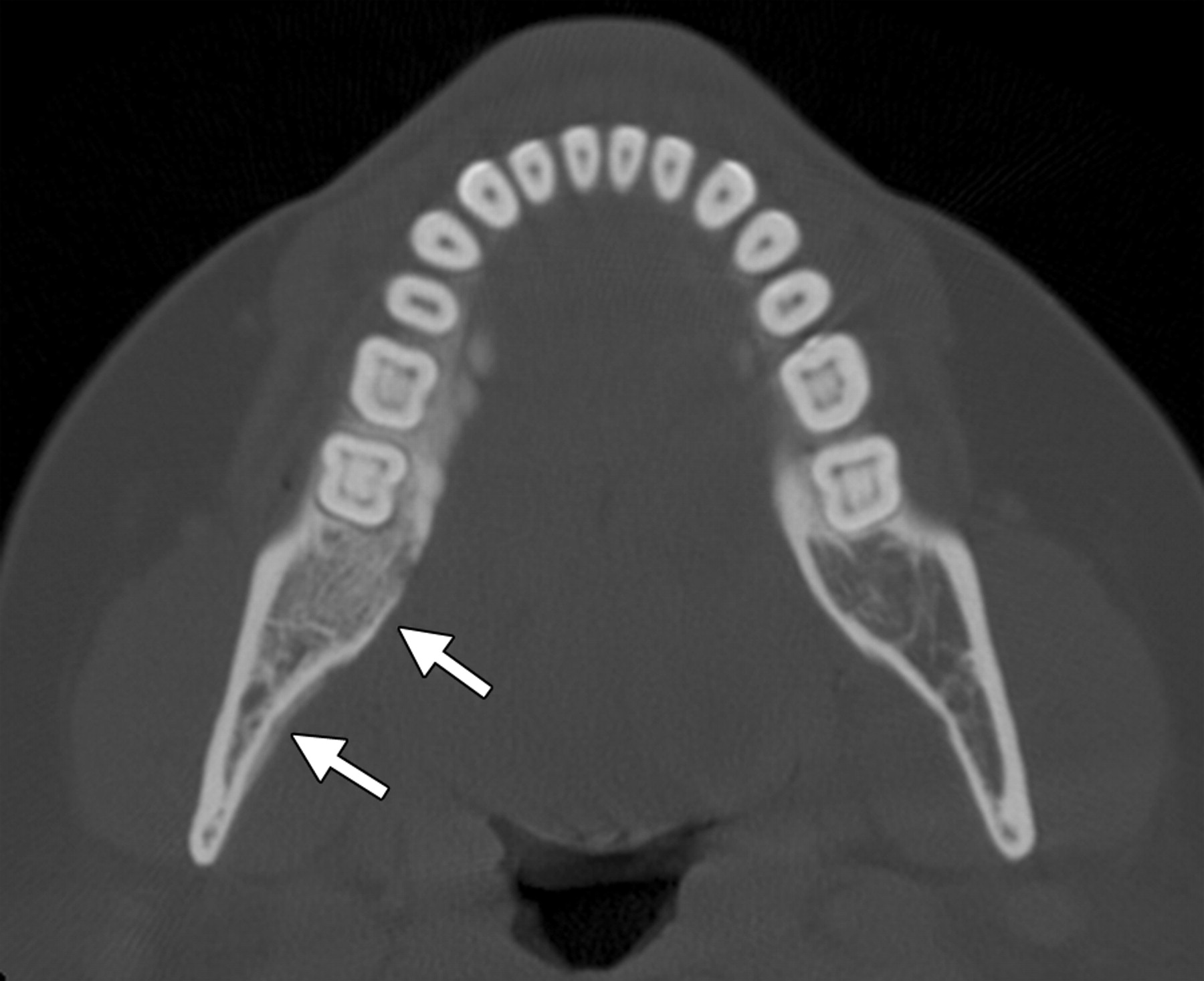 subtle medullary sclerosis and periosteal reaction in the right mandiblS