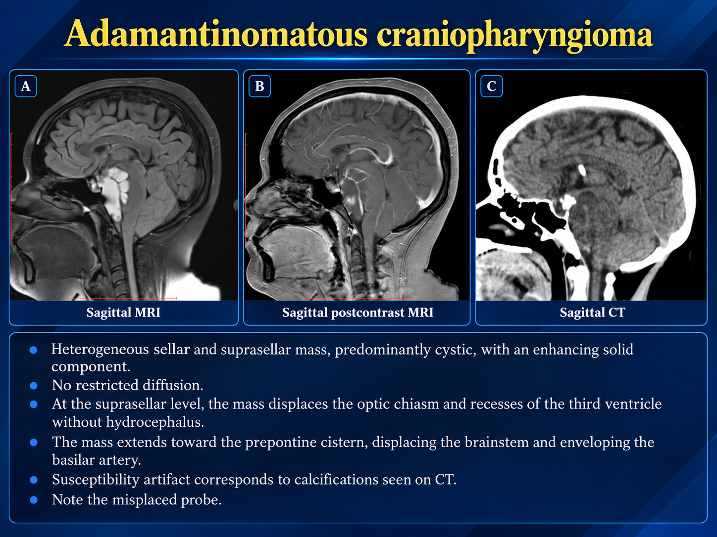 Sagittal MRI postcontrast MRI and CT findings of adamantinomatous craniopharyngioma
