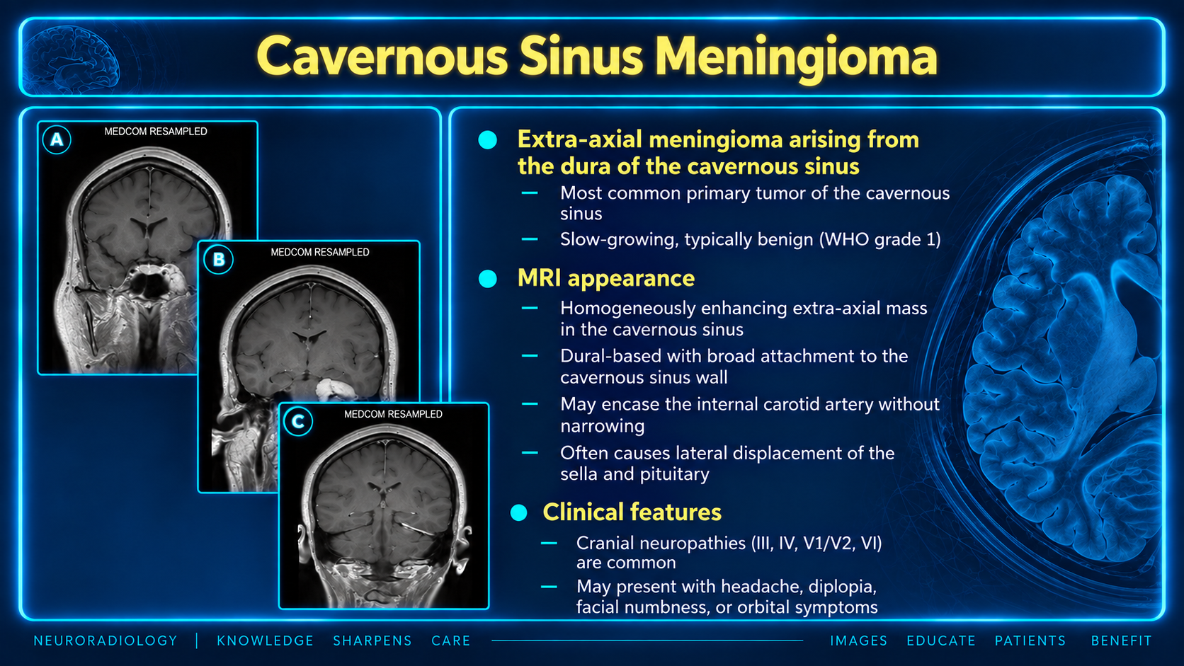 MRI appearance and clinical features of cavernous sinus meningioma