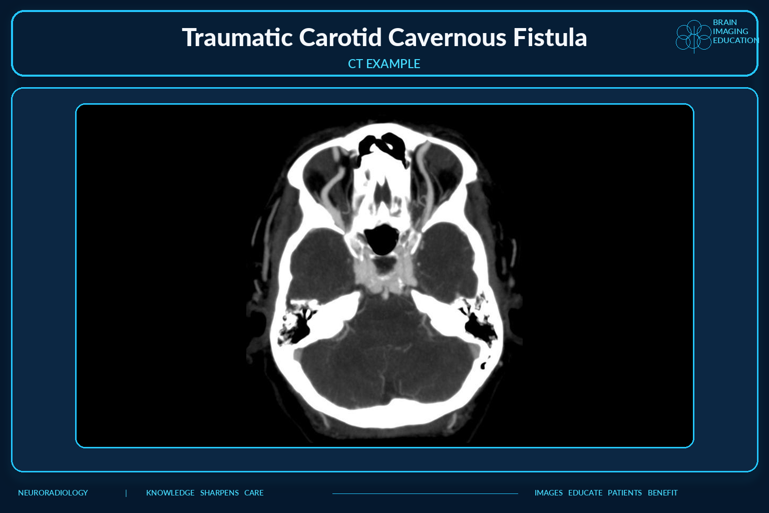 CT example of traumatic carotid cavernous fistula