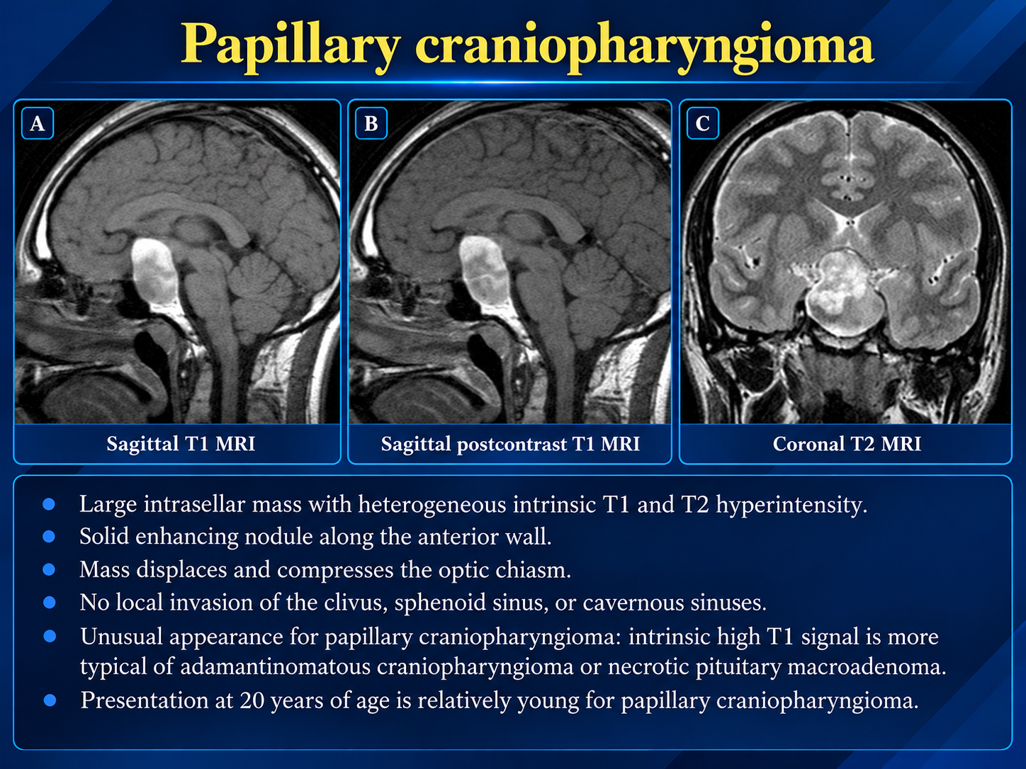 Sagittal and coronal MRI findings of papillary craniopharyngioma