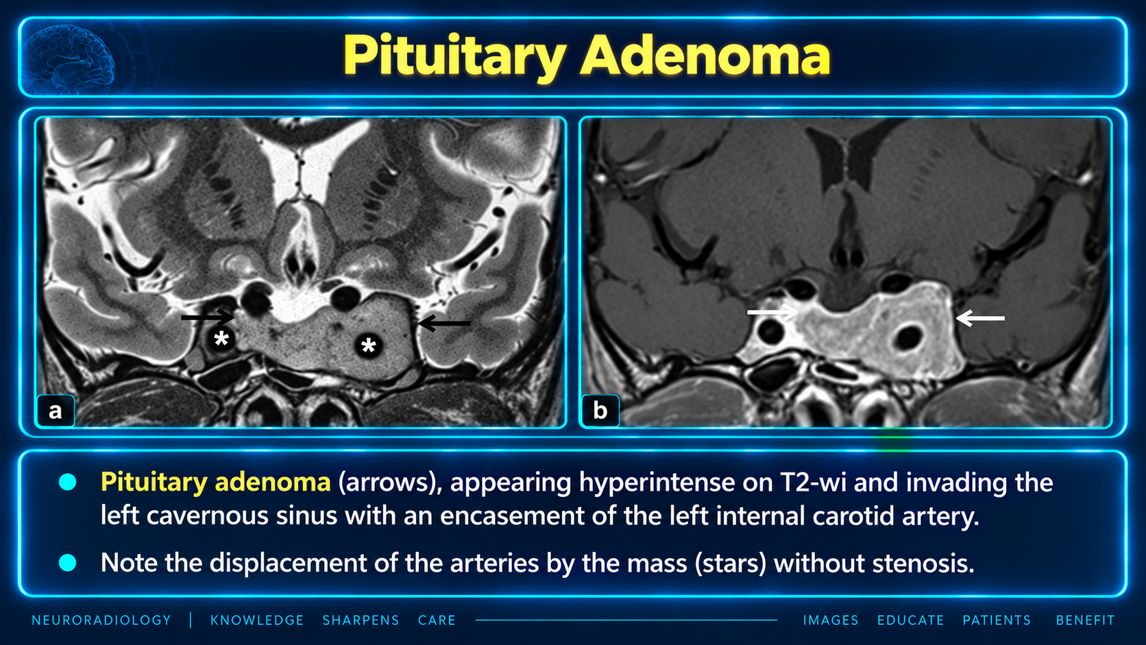 Pituitary adenoma invading the cavernous sinus and encasing the internal carotid artery