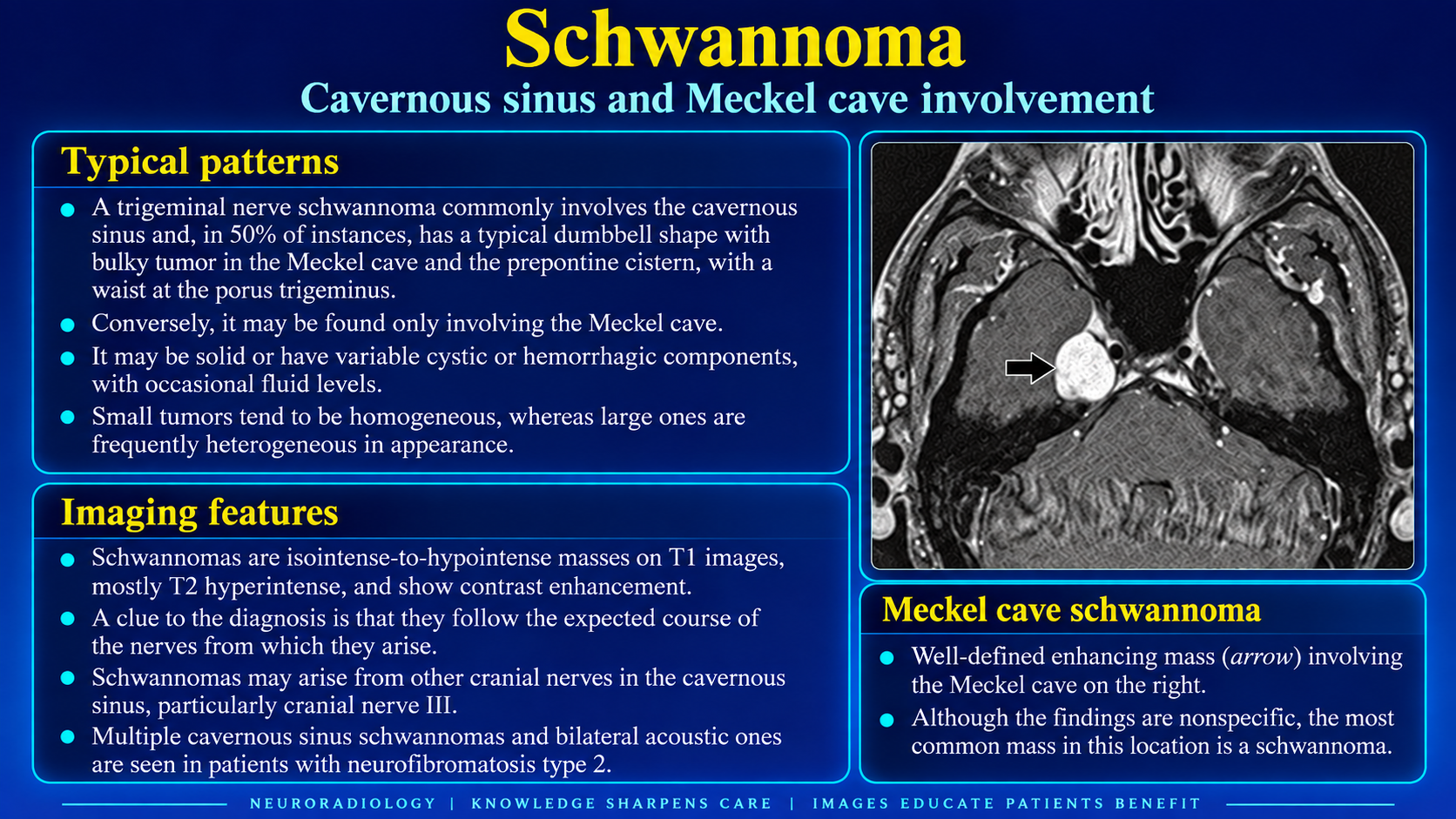 Schwannoma involving the cavernous sinus and Meckel cave