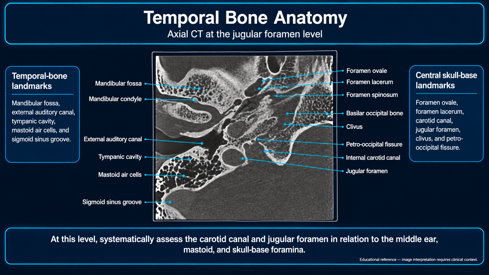 Labeled axial temporal-bone CT at the jugular foramen