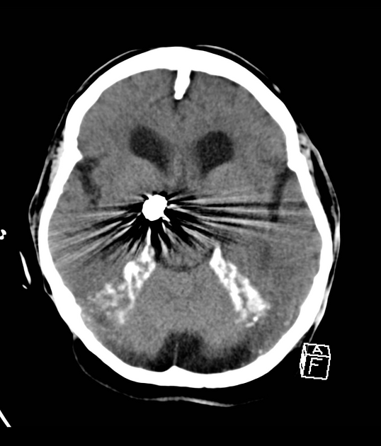 Calcified Tentorium