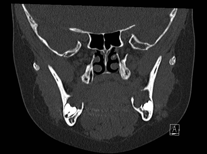 Odontogenic keratocysts