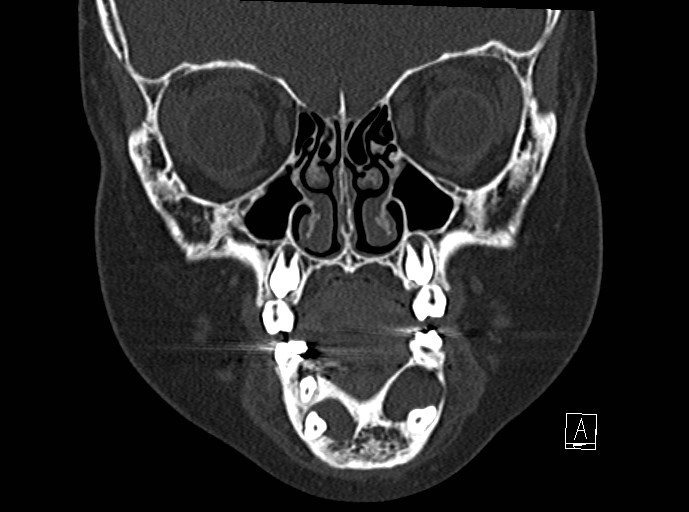 Odontogenic keratocysts