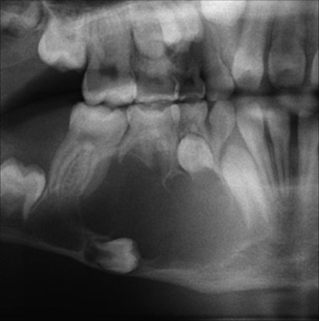 Odontogenic keratocyst