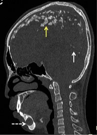 Pop corn lesions:



Extensive lamellar calcifications of the falx cerebri and tentorium, together with a mandibular cystic lesion suggestive of an odontogenic keratocyst, are highly characteristic.