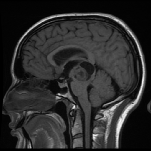 Midbrain