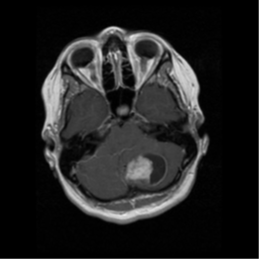 Patient A