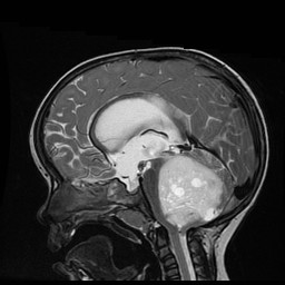 Pilocytic astrocytoma (path proven)



Posterior fossa mass containing cystic foci either originating from the fourth ventricles or invading it secondarily, responsible for obstructive hydrocephalus with transependymal resorption. 



ADC (not shown) demonstrates only moderate restricted diffusion. 



The differential diagnosis for this lesion includes medulloblastoma and pilocytic astrocytoma. A rarer tumor, atypical teratoid rhabdoid tumor (AT/RT) can also have this appearance, as could an ependymoma, although there is obvious intraparenchymal extension into the right cerebellar peduncle