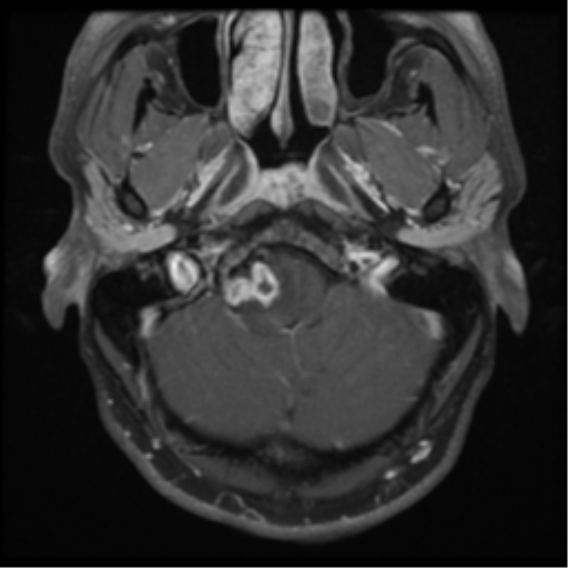 Brain Stem