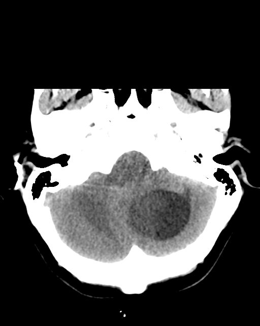 Patient A