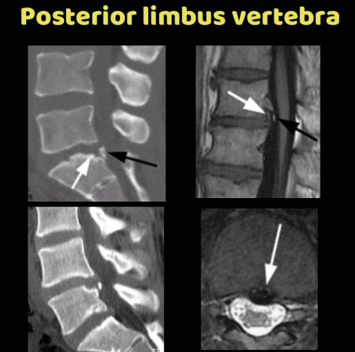 Posterior Limbus Vertebra