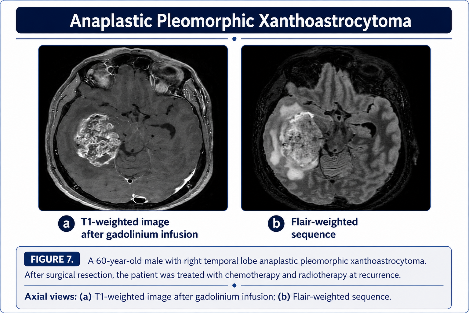 Anaplastic pleomorphic xanthoastrocytoma