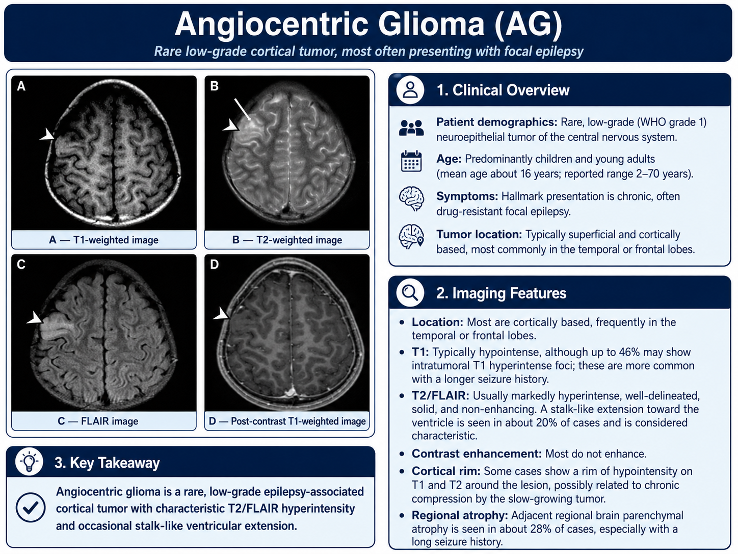 Angiocentric glioma